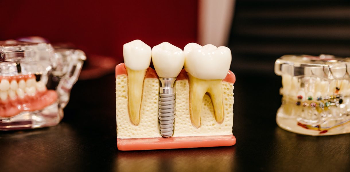 Neugierig, mehr über Zygoma-Zahnimplantate zu erfahren?