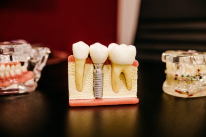 Neugierig, mehr über Zygoma-Zahnimplantate zu erfahren?